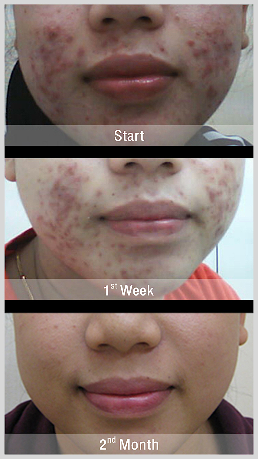 Acne Scar Treatment Bangkok