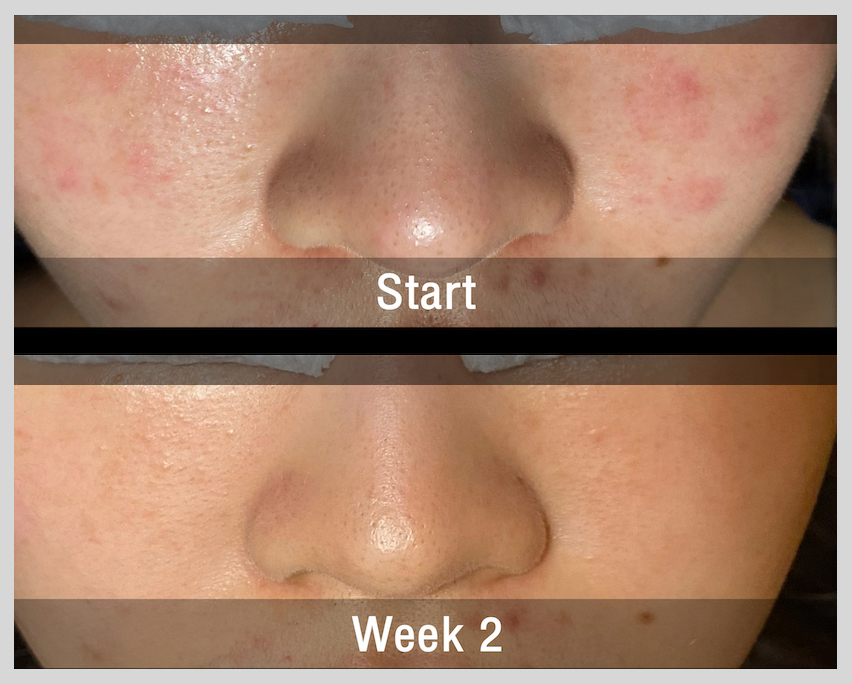 Acne Treatment Bangkok Thailand