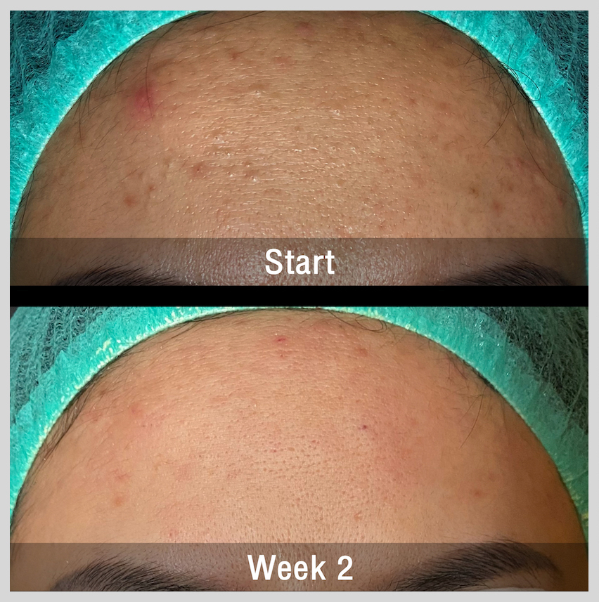 Acne Treatment Bangkok Thailand before and after