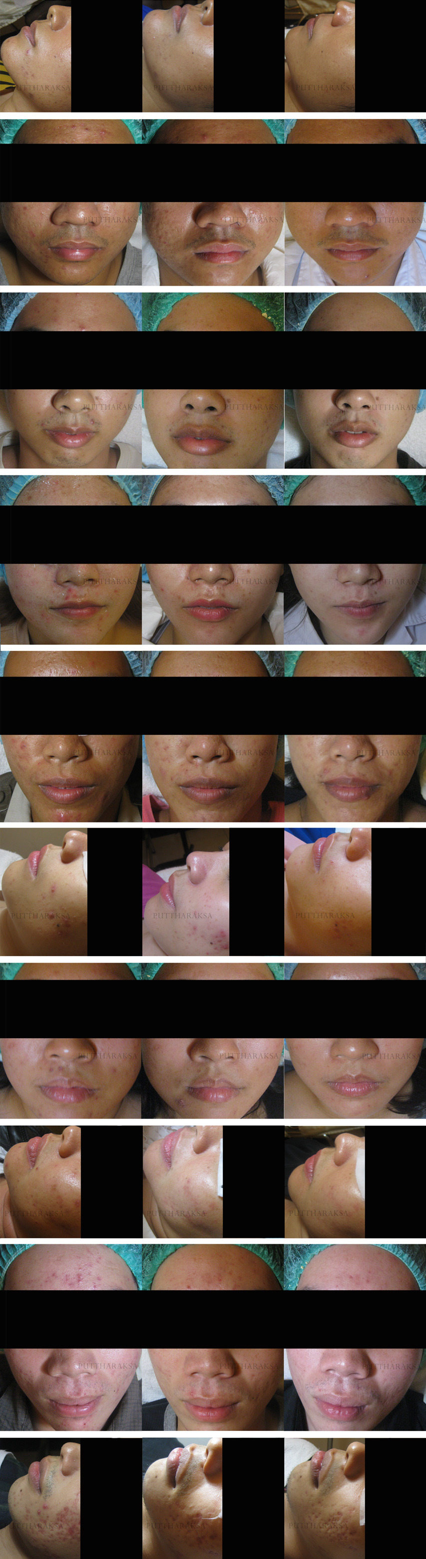 Acne Treatment Bangkok before and after