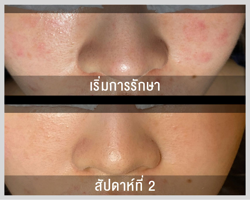 รักษาสิวผดที่ไหนดี | ลด ผดผื่น สิวอุดตัน ที่แก้ม ที่ไหนดี?  